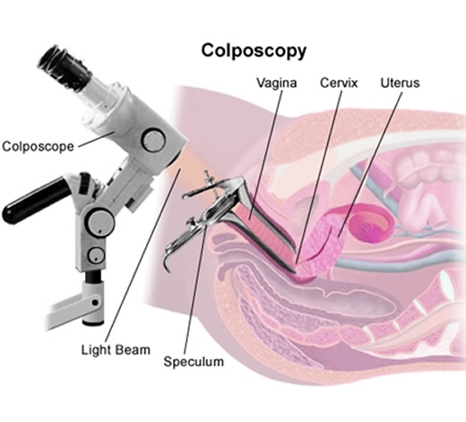 colposcop